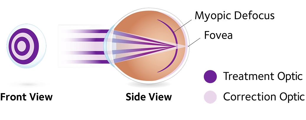 Illustrated infographic showing how mypoia affects the eye.