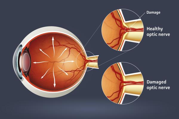 Glaucoma illustration.