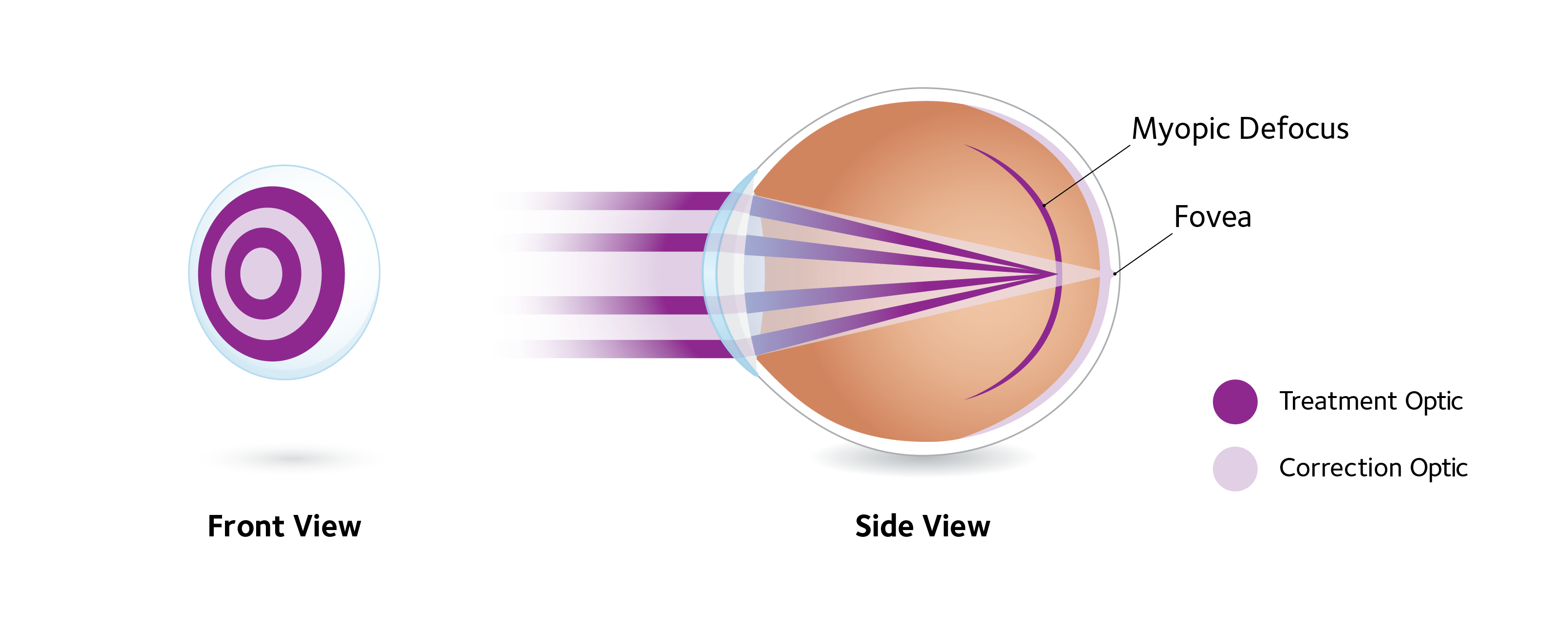 Technology diagram illustration - Front view of lens with alternating Treatment optic and Correction optic rings - Side View with Fovea at back of eye and Correction Optic zones reaching it and Myopic Defocus zone with Treatment Optic reaching it