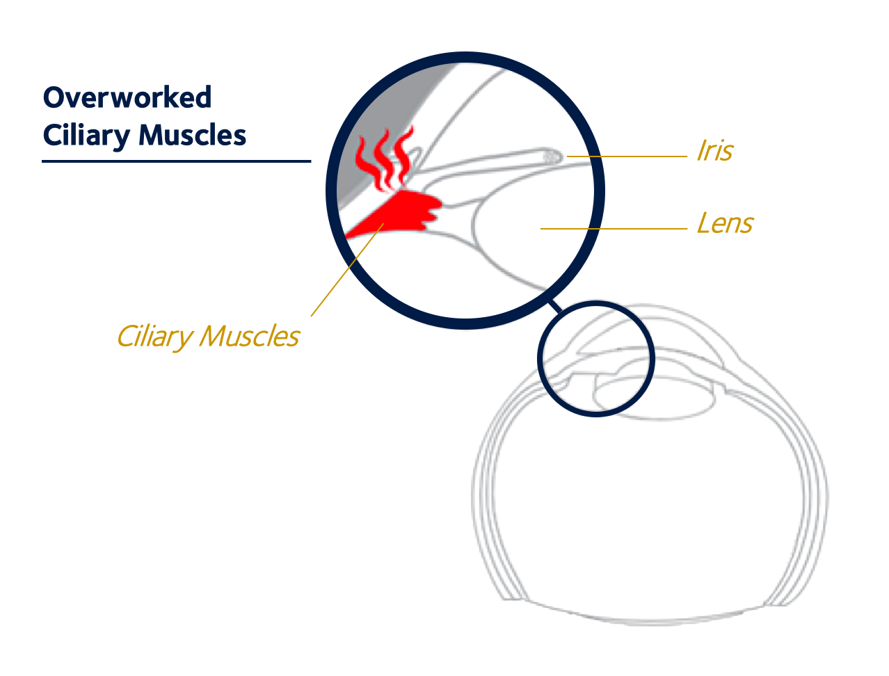 Overworked Ciliary Muscles illustration