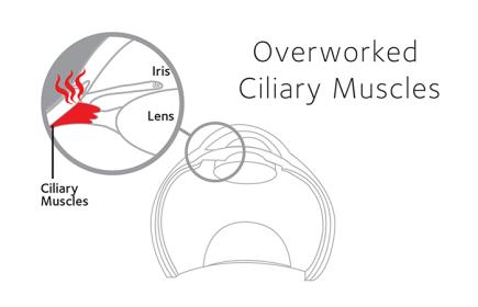 Overworked ciliary muscles