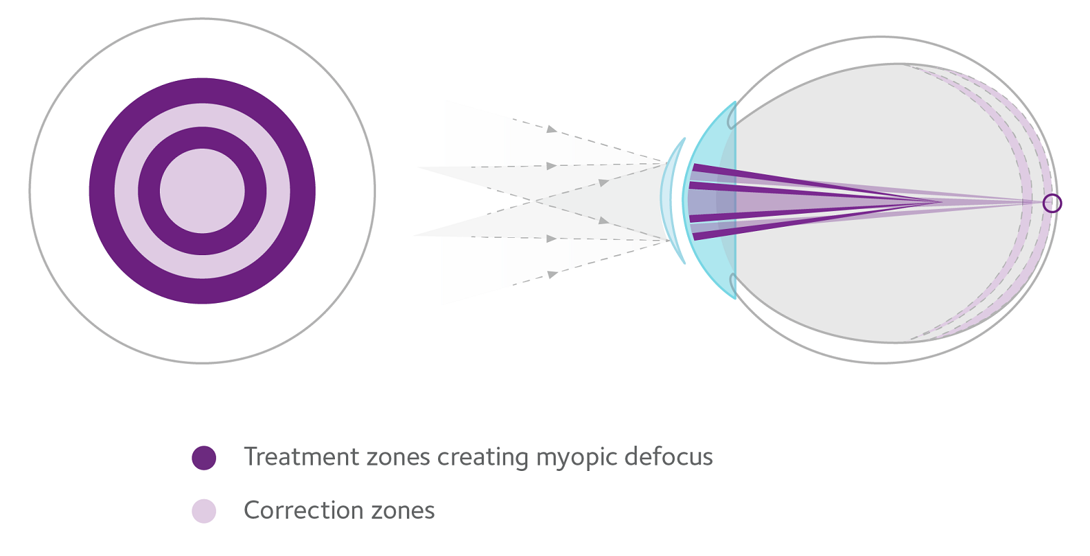 Treatment zones creating myopic defocus and correction zones